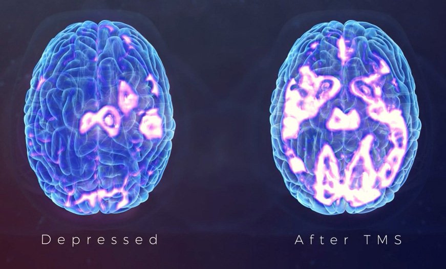 Comparison of brain activity before and after Transcranial Magnetic Stimulation TMS showing improved mood-related regions